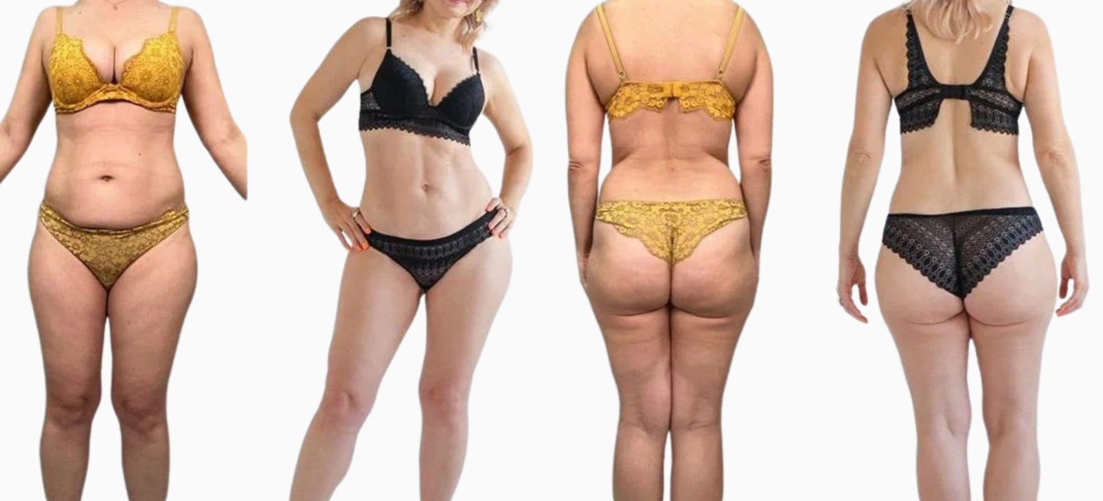 Результаты вибрационной липосакции на аппарате PAL LipoSculptor. Фото до и после